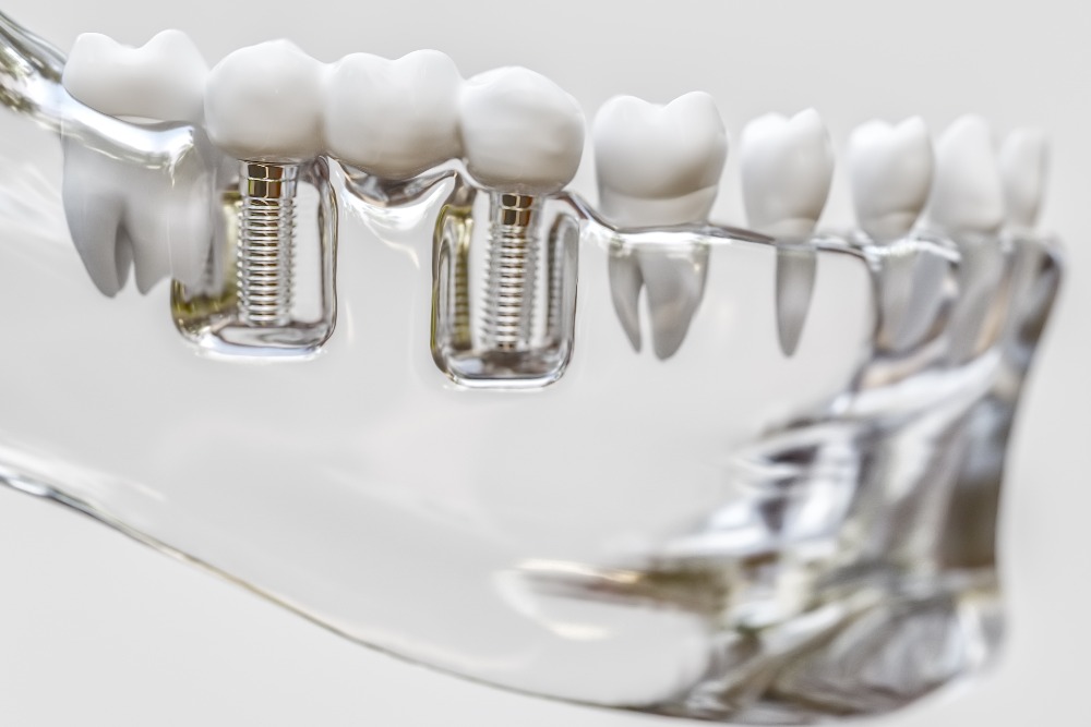 Tooth human implant 3d rendering jpg